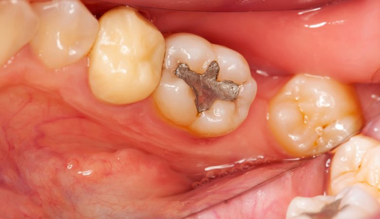 عوارض پر کردن دندان