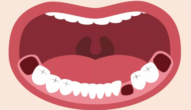بسته شدن حفره دندان کشیده شده