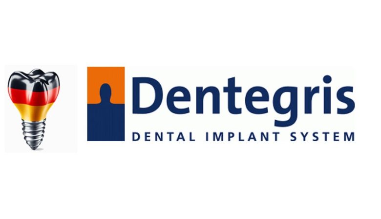 ایمپلنت دنتگریس